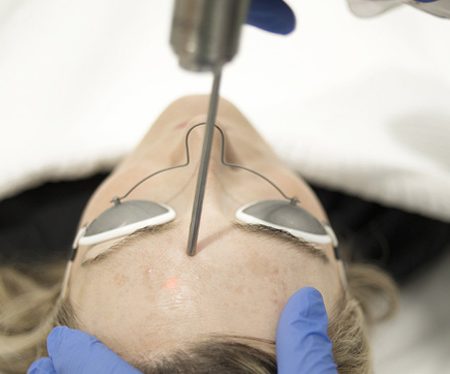 Tratamiento melasma