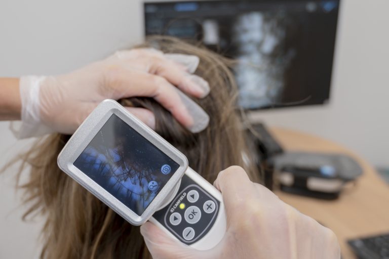 Redensificación capilar