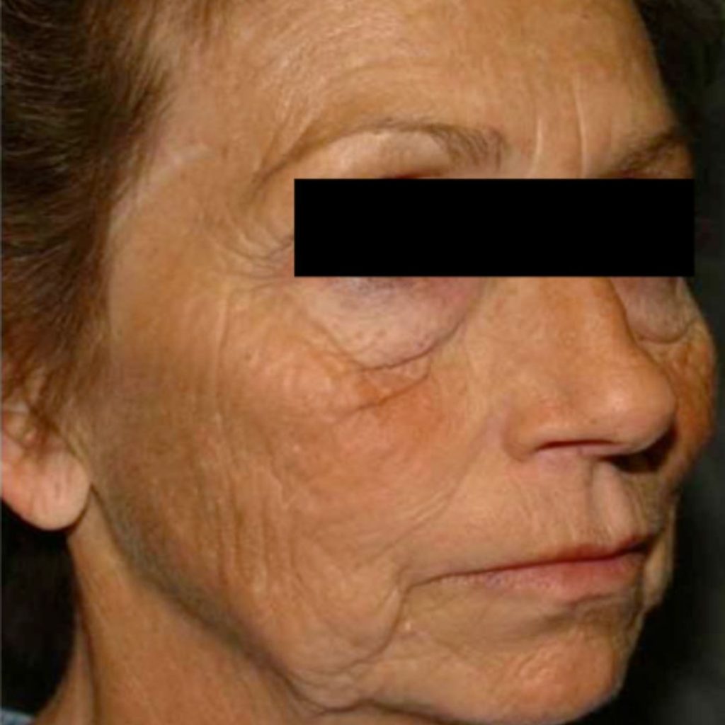 Antes de resurfacing facial