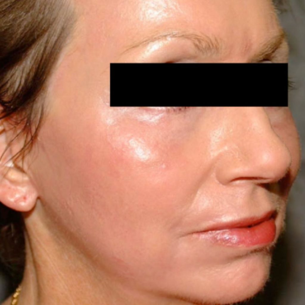 Después de resurfacing facial